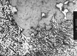 F,74y. | ossifying fibromyxoid tumor - submandibular gland